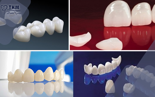 Các loại răng sứ phổ biến và được ưa chuộng hiện nay