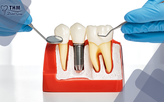 Các quy trình trồng răng Implant