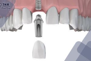 Cắm Implant răng cửa hiệu quả