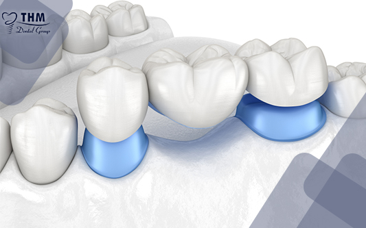 Cầu răng giả giúp lấp đầy những chỗ răng bị khuyết