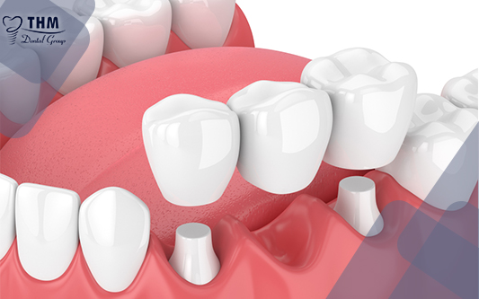 Cầu răng sứ là phương pháp trồng răng giả an toàn, thẩm mĩ cao mà giá cả bình dân
