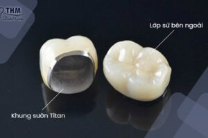 Bảng giá 109 Cấu tạo răng sứ Titan