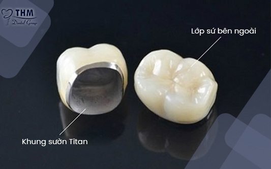 Cấu tạo răng sứ Titan