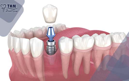 Cấy Răng Implant