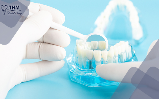 Chia sẻ những điều thú vị về làm răng Implant mà bạn chưa biết?