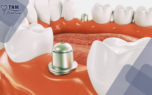Figure 1 dental Implant