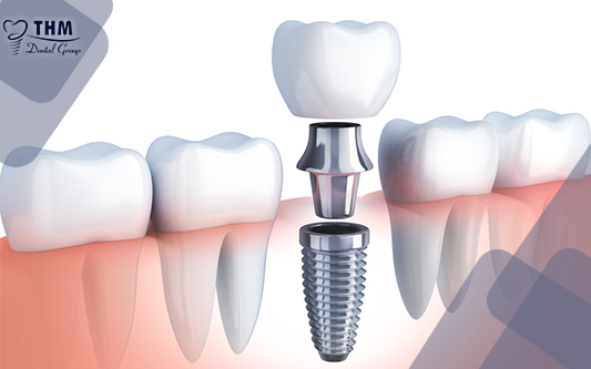 Figure 2 dental Implant