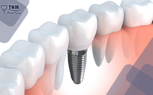 Figure 3 dental Implant