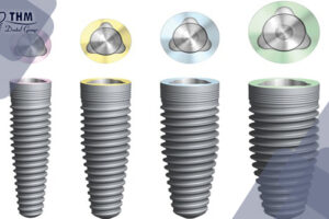 Bảng giá 102 Implant Thụy Sỹ