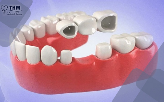Keo dán răng sứ trong phương pháp cầu răng sứ