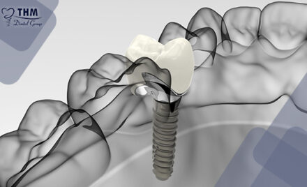 Kinh nghiệm làm răng Implant cho một hàm răng đẹp, tự tin