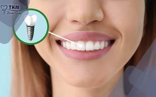 Nha khoa Thế Hệ Mới chuyên sâu trong việc cắm Implant răng cửa