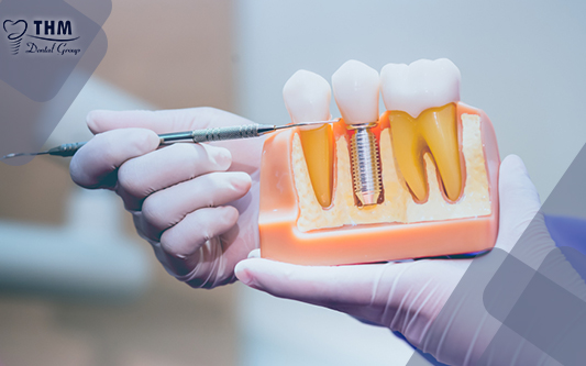 Nha khoa thế hệ mới địa chỉ vàng cho trồng răng Implant