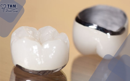 Những điều bạn chưa biết về răng sứ kim loại?