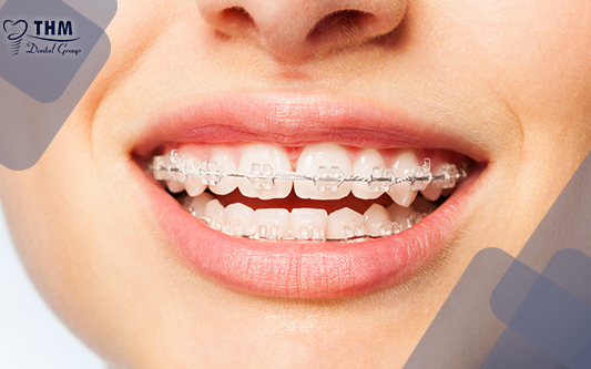 Niềng răng mắc cài sứ là phương pháp chỉnh răng được ưa chuộng thời gian gần đây