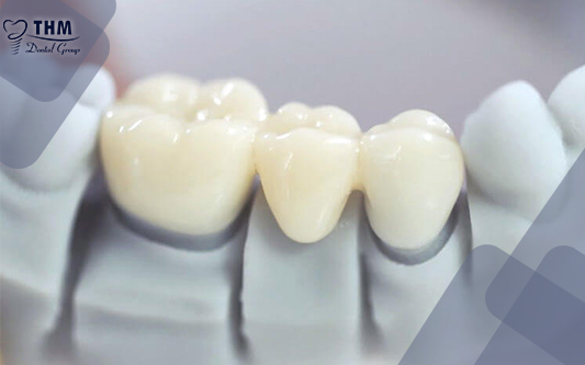 Phục hình răng sứ chính là phương pháp nha khoa được nhiều người lựa chọn