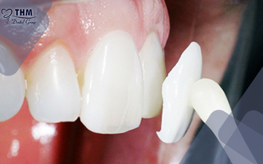 Phương pháp gắn răng sứ phổ biến