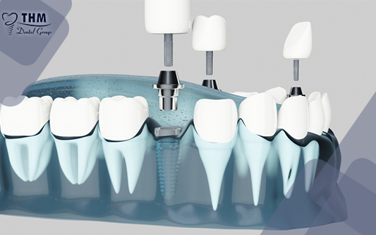 Phương pháp rút ngắn thời gian trồng răng Implant