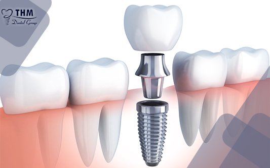 Phương pháp trồng răng Implant có đau không?
