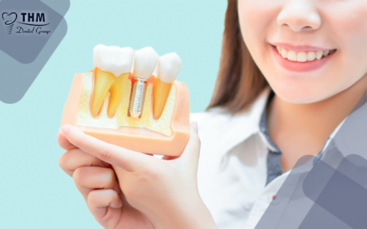 Phương pháp trồng răng Implant với công nghệ hiện đại mang lại hàm răng sáng khỏe cho bạn