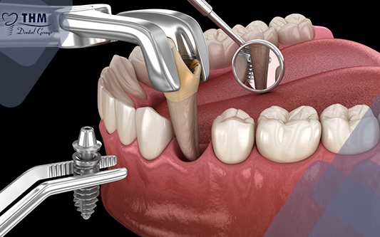 Quy trình trồng răng Implant diễn ra thế nào?
