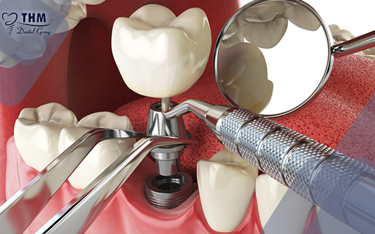 Quy trình trồng răng implant
