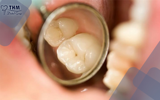 Răng bị sâu nên đi làm răng sứ để bảo vệ chiếc răng sâu