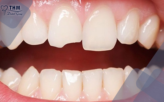 Răng được chỉ định chụp răng sứ