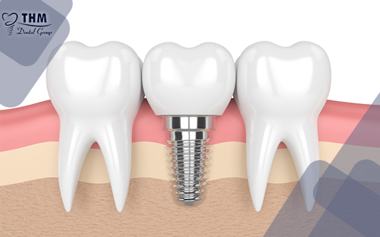 Răng implant được trồng vĩnh viễn có đủ thân và chân răng