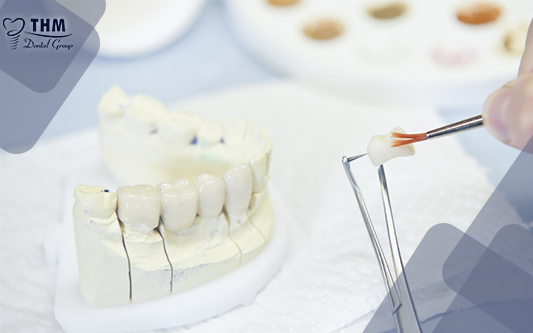 Răng sứ được cố định trên răng thật bằng một lớp xi măng nha khoa