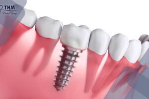 Bảng giá 110 Răng sứ Implant giá bao nhiêu tiền