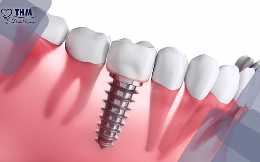 Răng sứ Implant giá bao nhiêu tiền