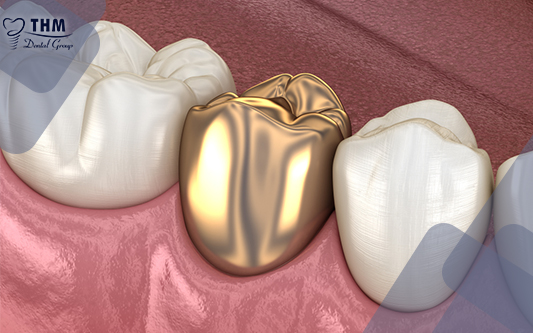 Răng sứ kim loại quý rất tốn kém nhưng luôn mang lại giá trị hiệu quả cao