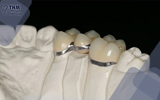 Răng sứ kim loại thường không gây kích ứng đến răng