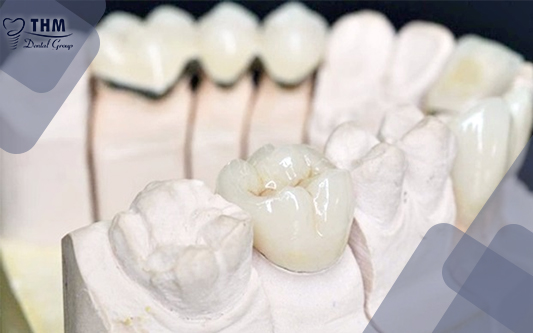 Răng sứ titan có độ tương thích màu sắc không cao