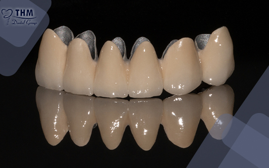 Răng sứ titan có tuổi thọ trung bình dao động trong khoảng 10 năm đến 15 năm