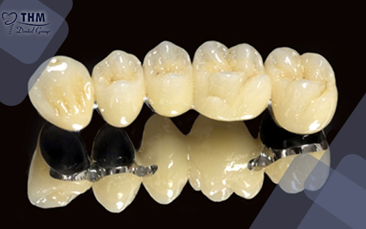 Răng sứ titan và những điều cần biết