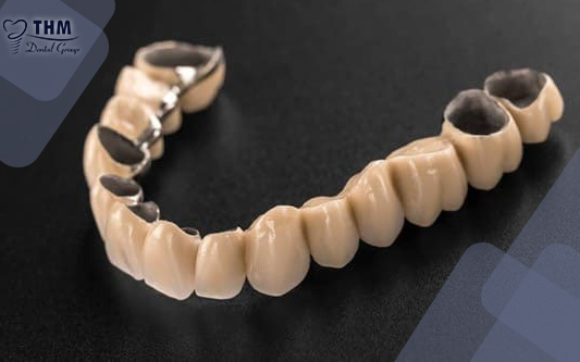 Răng sứ titan với khả năng chống ăn mòn cực cao
