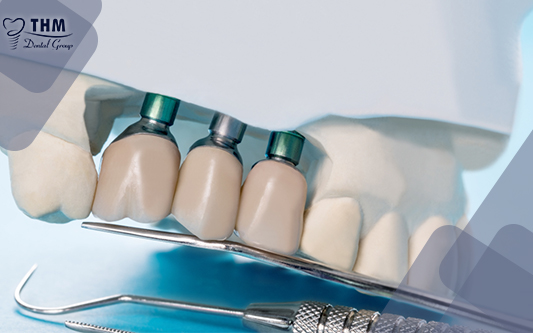 Tại sao nên trồng răng Implant