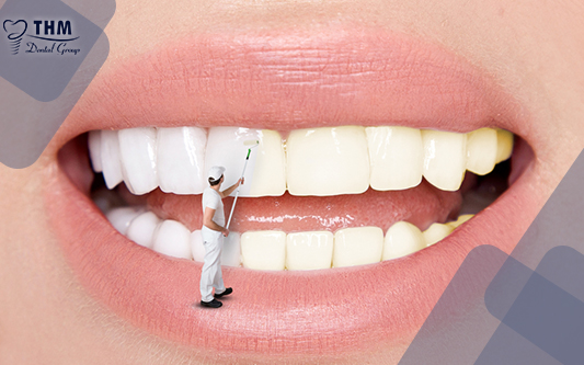 Tẩy trắng răng là phương pháp làm sáng răng phổ biến nhất hiện nay