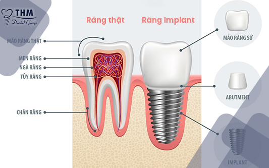 Thành phần trụ răng Implant có chức năng giống trụ răng thật