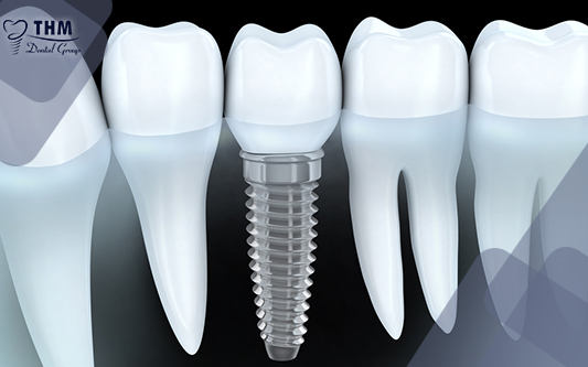 Liệu rằng việc trồng răng Implant có nguy hiểm không?