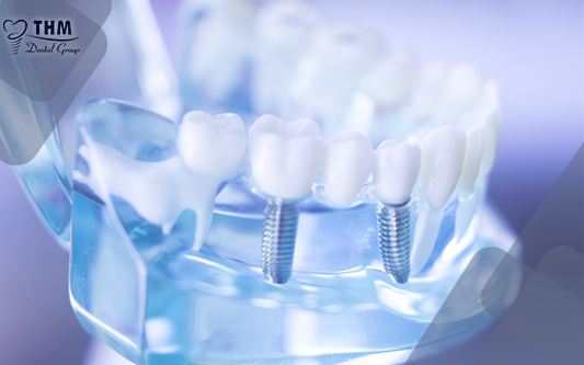 Trồng răng Implant mang lại nhiều lợi ích cho bạn
