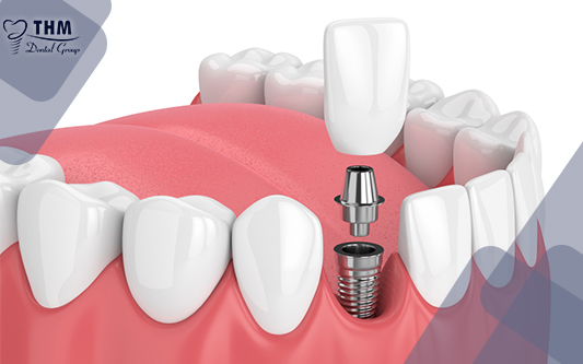 Trồng răng Implant giải pháp tuyệt vời cho bạn