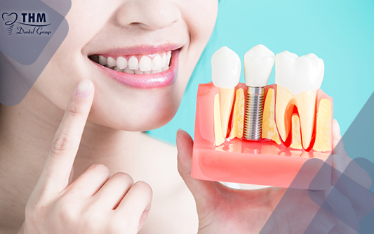 Trồng răng Implant giúp hàm răng trắng sáng, đều màu