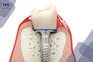 Trồng răng Implant khắc phục tiêu xương hàm