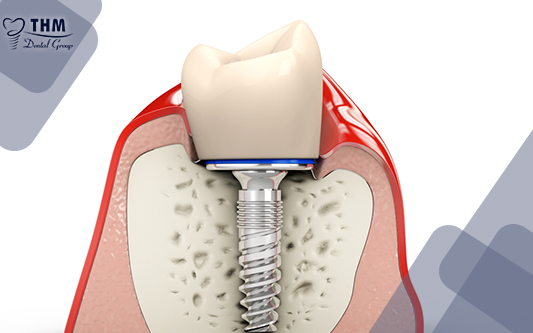 Trồng răng Implant khắc phục tiêu xương hàm