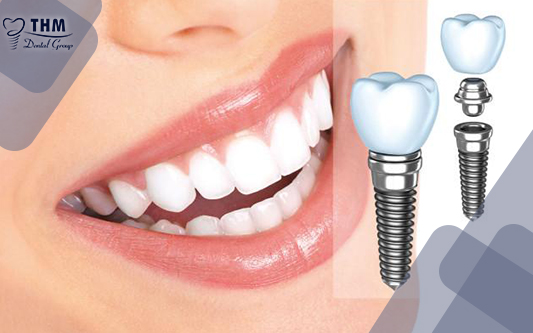 Trồng răng implant hiện nay là giải pháp tuyệt vời để phục hình răng