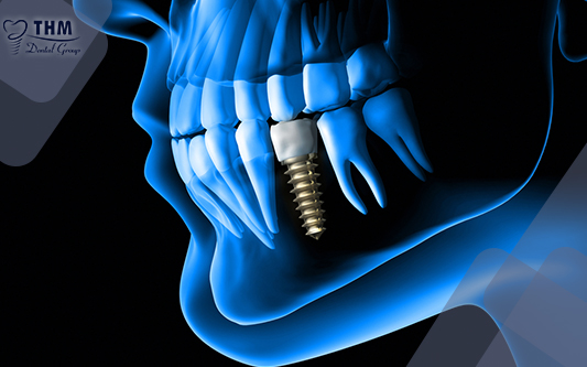 Trồng răng Implant là giải pháp cấy trụ chân răng vào xương hàm