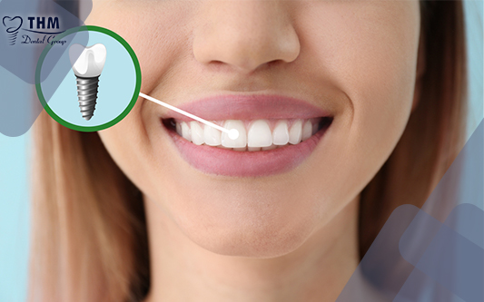 Trồng răng implant mang lại nụ cười tự tin nhất cho bạn